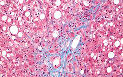 Liver Biopsy in Type 2 Diabetes: Implications for NASH